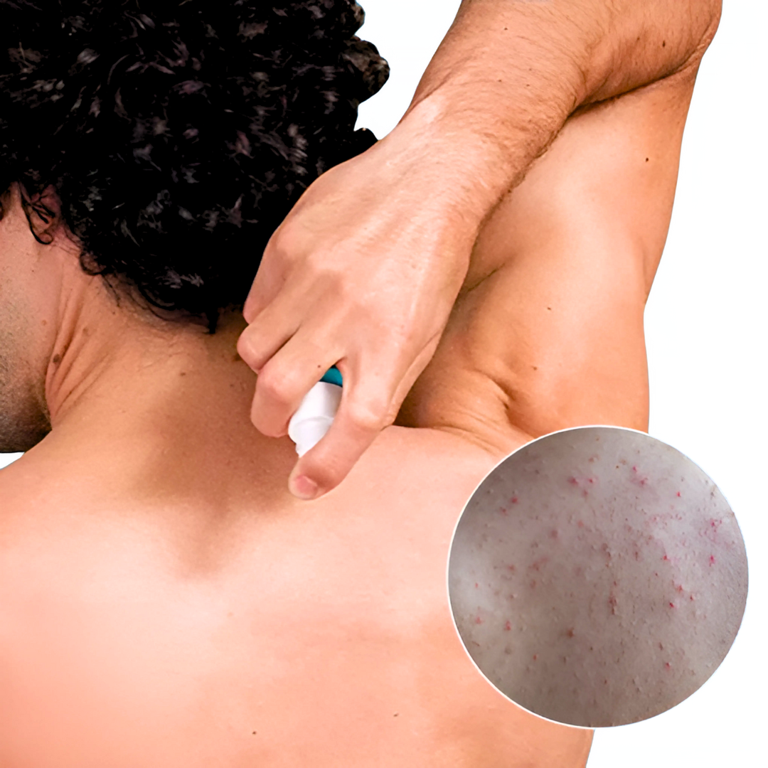 Sprej za Akne na Ledjima