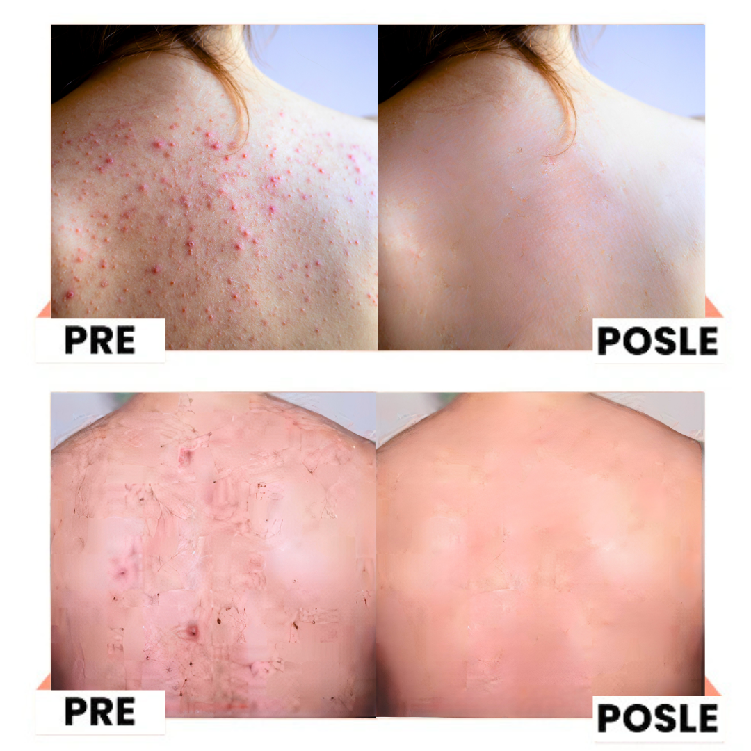 Sprej za Akne na Ledjima